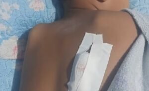 criança ferida por vergalhão em Soure